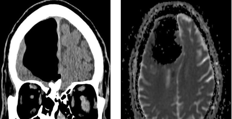 Anomaly in the brain of an Irishman struck doctors