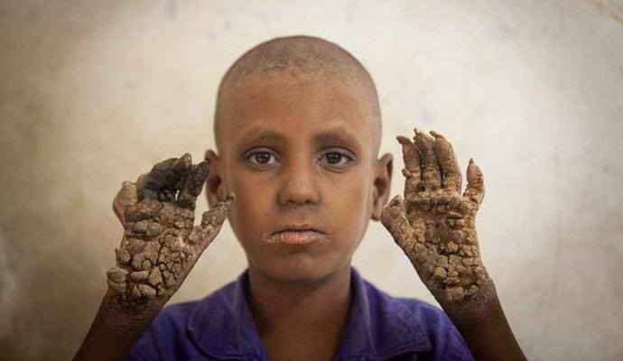 Bangladeshi boy turns into a tree