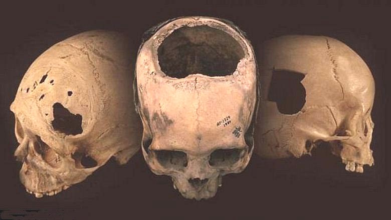 Ancient Incas did professional craniotomy