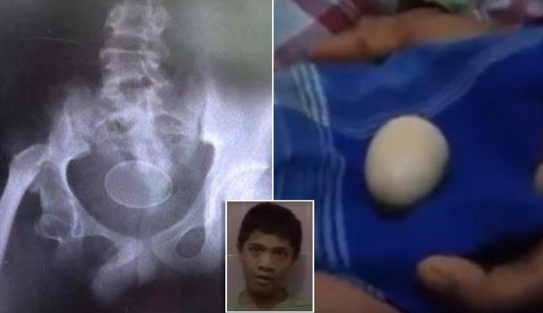 Indonesian egg-laying teen surprised doctors