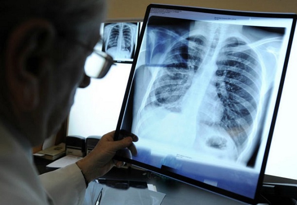 A Chinese woman broke ten ribs due to a strong fit of coughing: sunblock is to blame