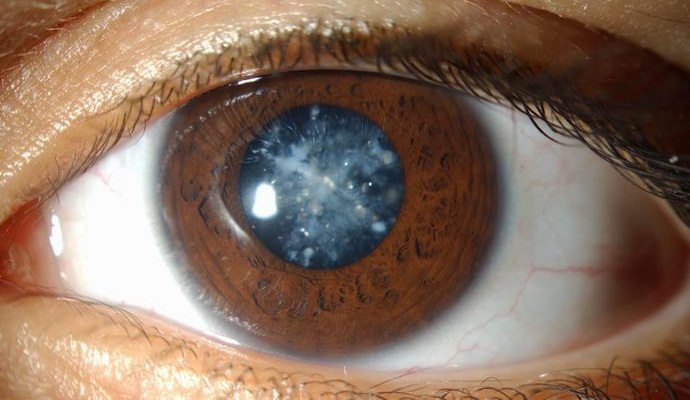 Stem cell cataract treatment has shown excellent results.