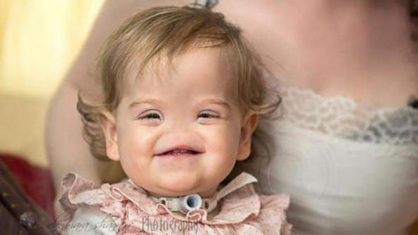 A rare disease: a girl without a nose was born in Britain