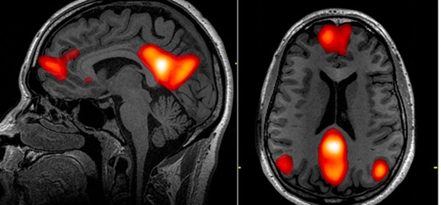 Brain scans reveal full spectrum of COVID-19 anomalies scientists cannot explain 