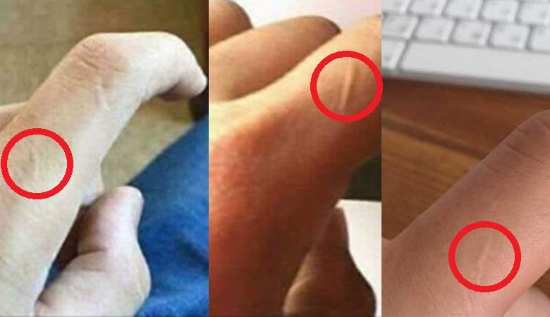 Many people have found a mysterious scar on the index finger