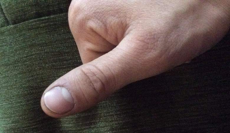 Amazing cases of finger regeneration