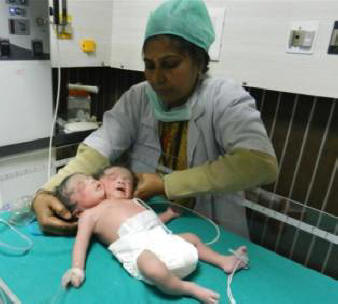 In India, a baby with two heads was born