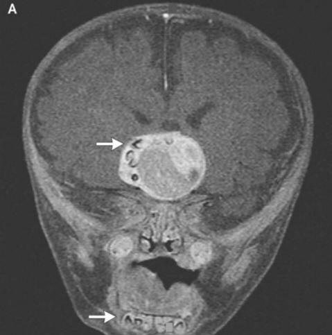 A tooth has grown in the boy’s brain