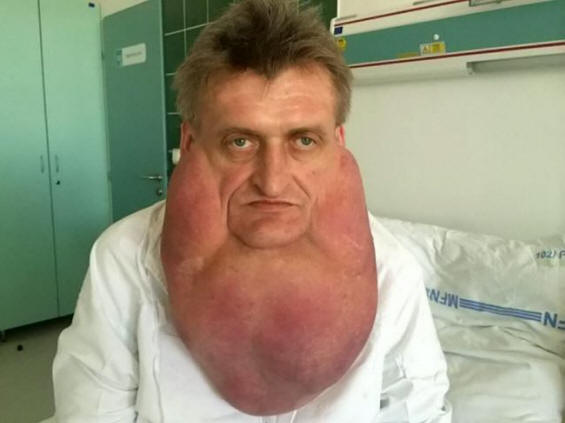 Doctors removed a giant tumor from a man’s face